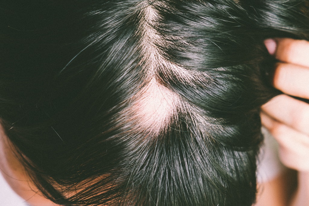 What is alopecia? Causes and treatments for hair loss