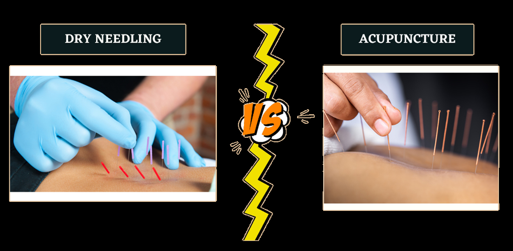 Dry Needling vs Acupuncture