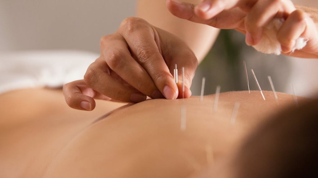 Cost Comparison Dry Needling vs Acupuncture